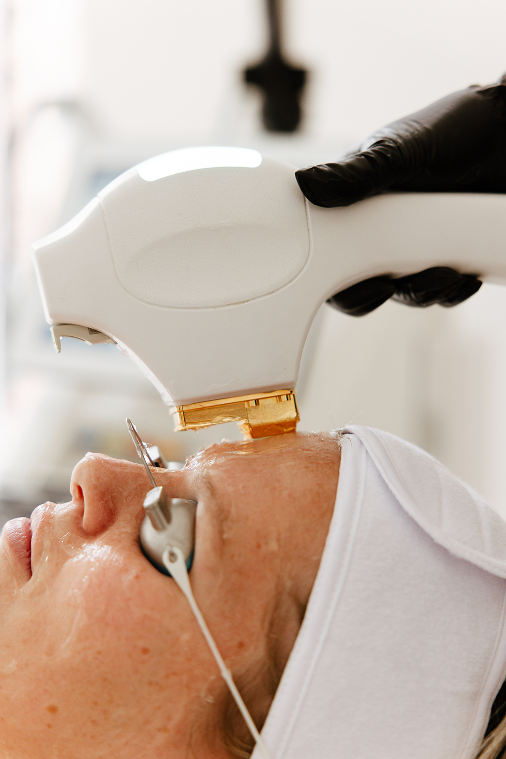 BBL HEROic fototerapia szerokopasmowa – efekty odmłodzenia skóry, Warszawa