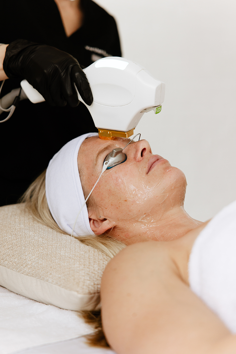 Zabieg BBL HEROic Sciton – redukcja przebarvień i rumienia, Aestheco Warsaw