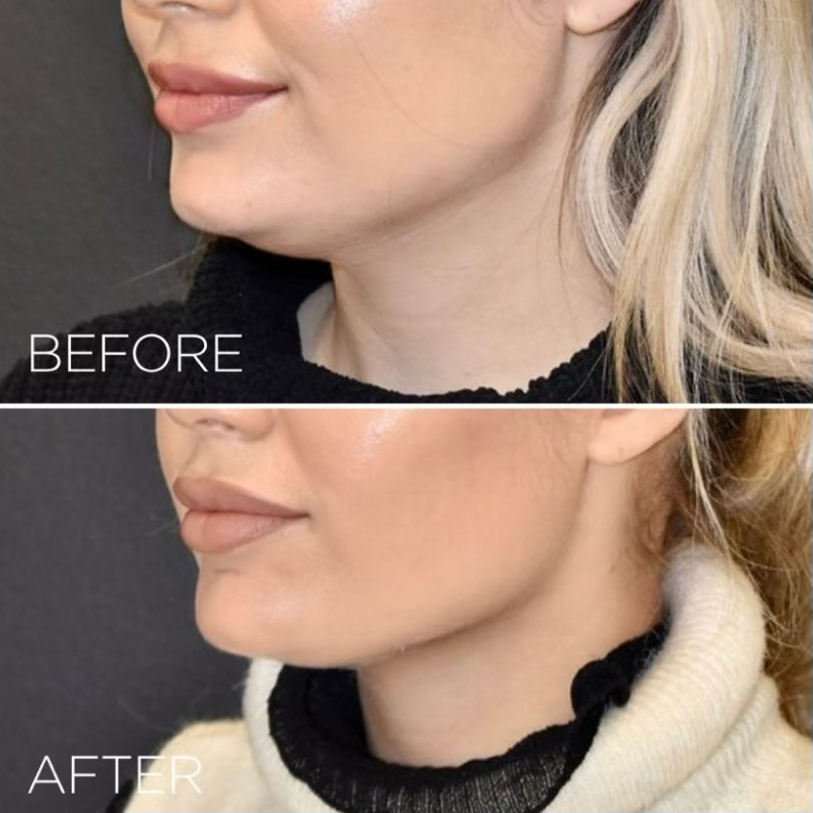 HIFU Ultherapy PRIME® – stymulacja kolagenu, lifting bez skalpela, Warszawa