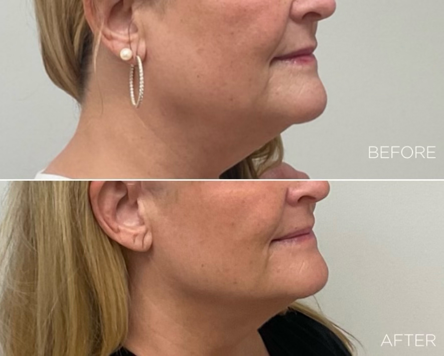 Ultherapy PRIME® – nieinwazyjny lifting twarzy, dr Pitucha Warszawa