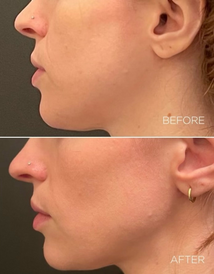 Zabieg HIFU Ultherapy – poprawa owalu twarzy i szyi, Aestheco Warsaw