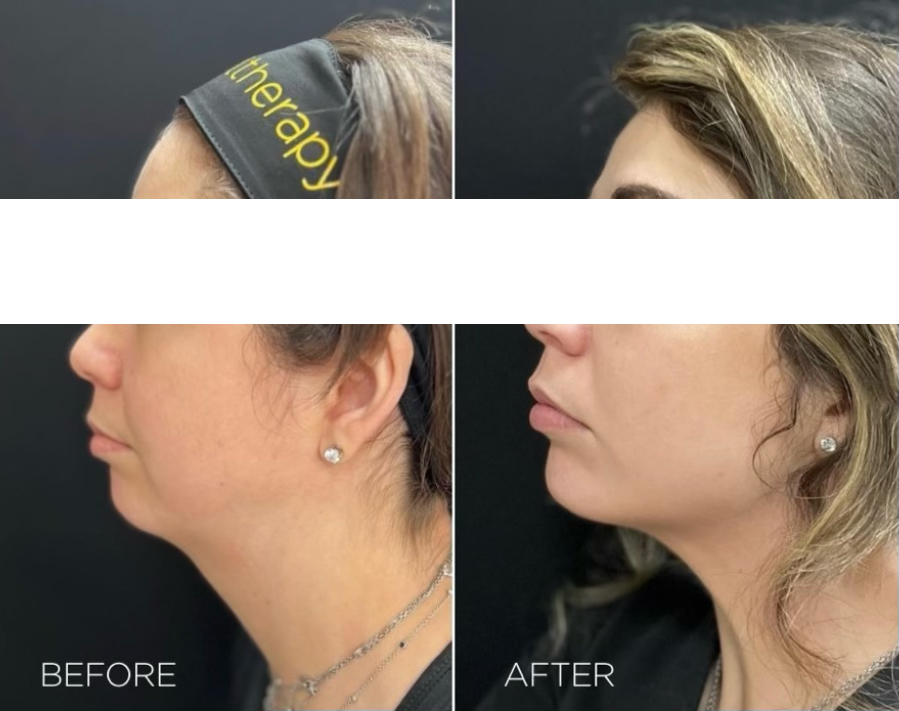 Zabieg HIFU Ultherapy PRIME® w Aestheco Warsaw – lifting szyi i twarzy