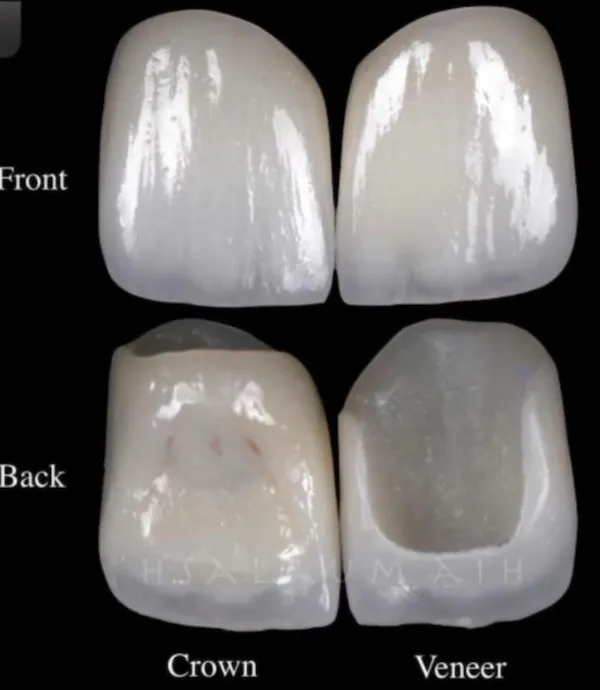 Front and back of Crowns and Veneers