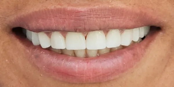 Patient with a beautiful smile after undergoing a Smile Makeover at Jonari Dental in Cooper City.