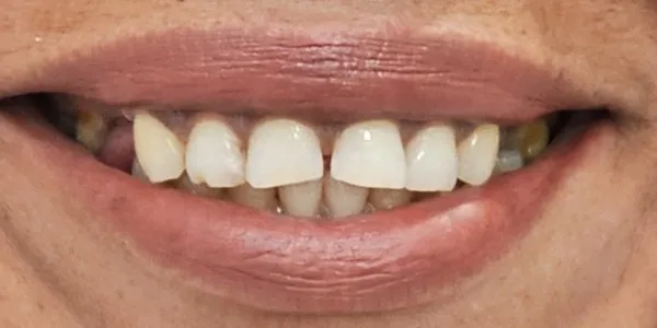 atient with broken, stained, and spaced teeth.