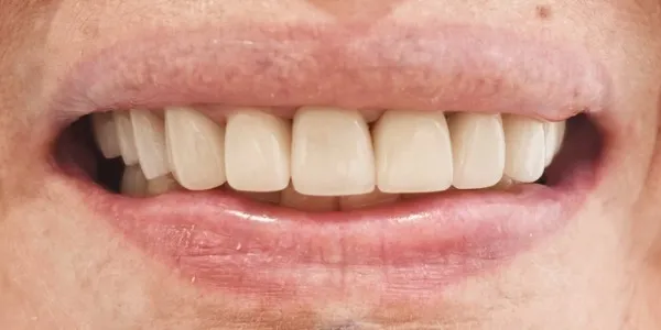 Patient with a beautiful smile after undergoing a Smile Improvement at Jonari Dental in Cooper City.