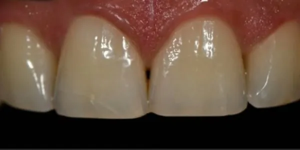 Patient after undergoing an enameloplasty at Jonari Dental in Cooper City.