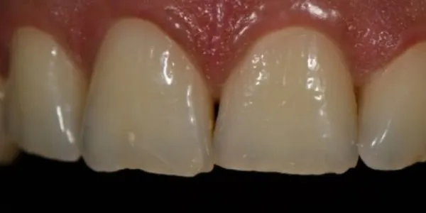 Patient with stained and fractured teeth.