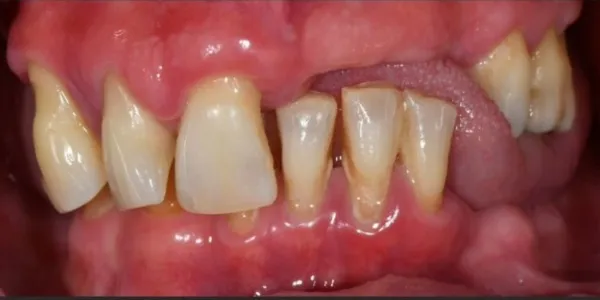 Patient with stained, elongated, and missing teeth.