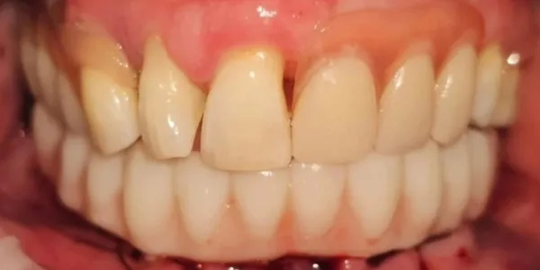 Patient with a perfect smile after a smile design with 6 implants and an upper partial denture at Jonari Dental in Cooper city.