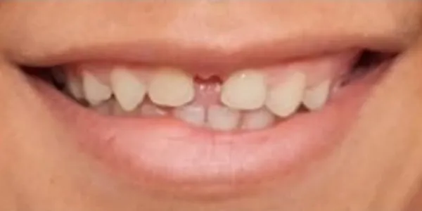 Patient with stained and spaced teeth.