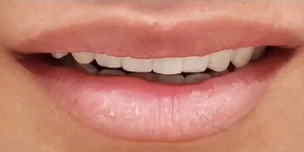 Patient with a perfect smile design after getting provisional restorations at Jonari Dental in Cooper City.