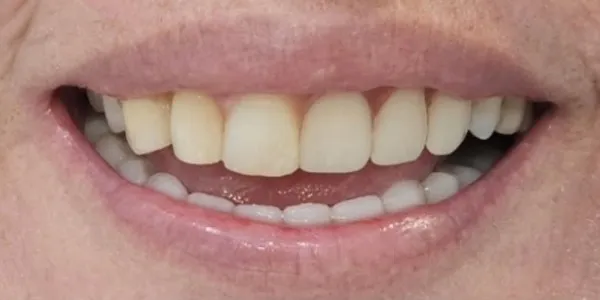 Close-up of a patient’s beautiful smile after smile design with six dental implants and an upper partial denture.