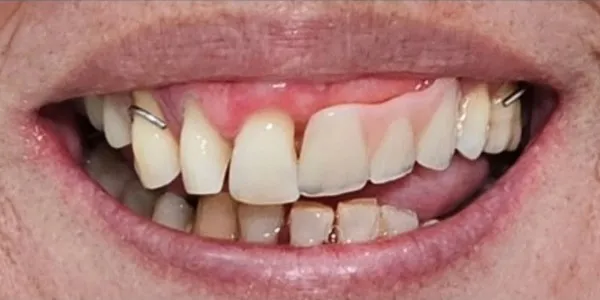 The patient had stained and fractured teeth, along with an old removable denture
