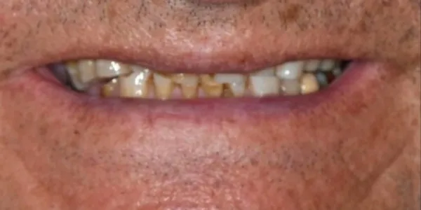 Close-up of a patient’s mouth showing broken, stained, and missing teeth before smile design with four dental implants at Jonari Dental in Cooper city.