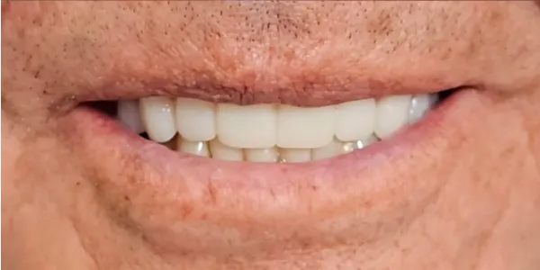 Close-up of a patient’s beautiful smile after smile design treatment with four dental implants.