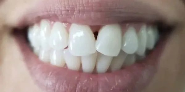 Close-up of a patient's smile showing gaps between the upper teeth before smile design treatment.