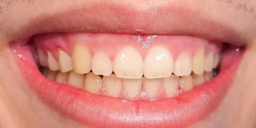 Gingivectomy — antes