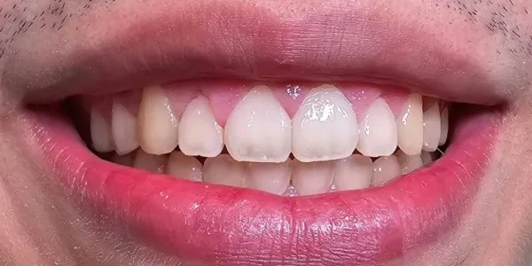 Patient smiling after a gingivectomy at Jonari Dental in Cooper city.