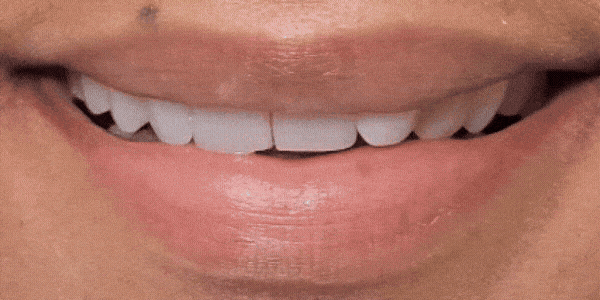 Close-up of a Smile Design made on Jonari Dental of Cooper City, FL