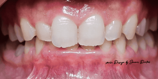 Patient with stained and fractured teeth, before and after a smile design with veneers at Jonari Dental in Cooper City.