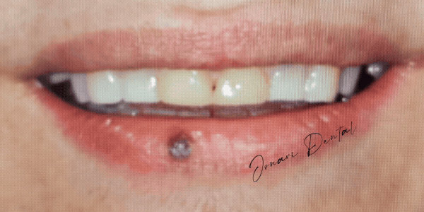 Close-up of a Smile Design made on Jonari Dental of Cooper City