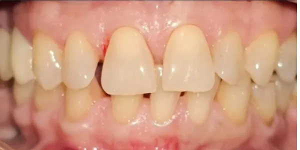 Patient with stained teeth and gaps (diastemas) before undergoing a smile design with veneers at Jonari Dental in Cooper City