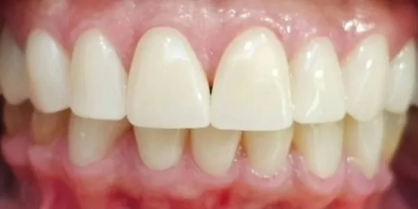 Patient with a perfect smile after a smile design with veneers at Jonari Dental in Cooper City.