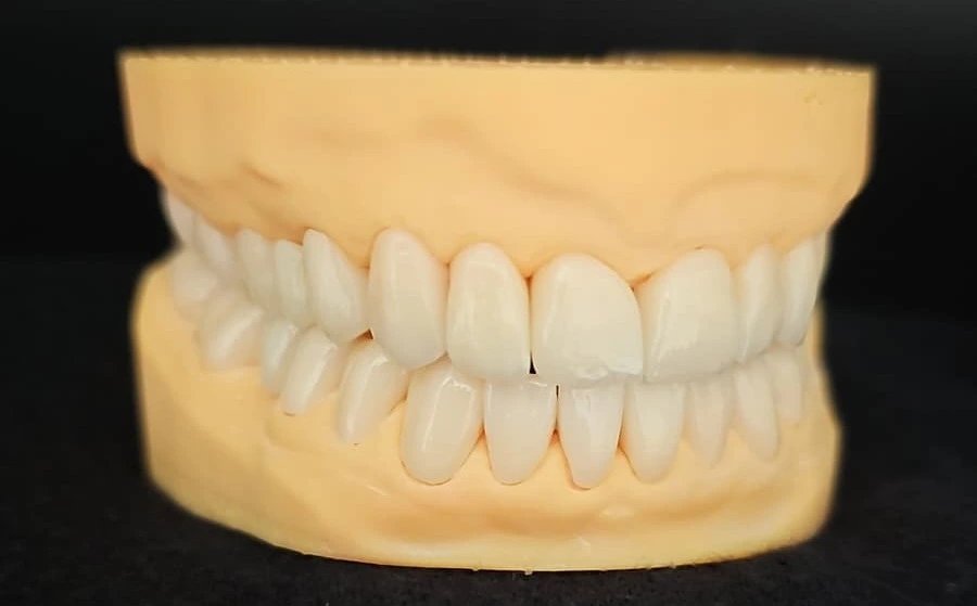 Crowns & Veneers