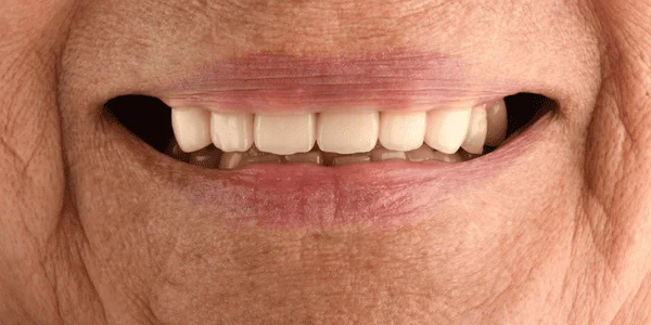 Smile Design — antes