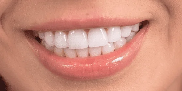 Smile Design — después