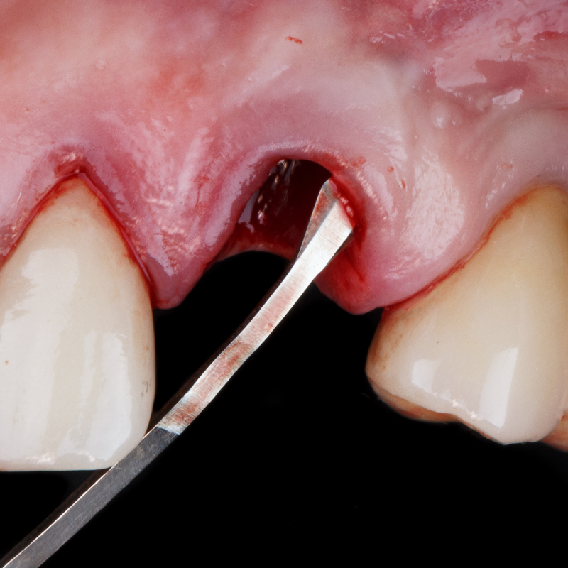 Bone Grafting for Dental Implants in Kondapur