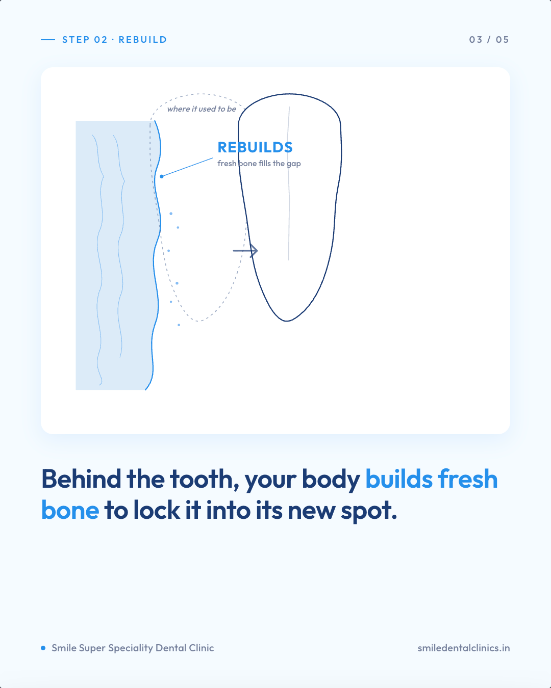 Diagram of new bone forming on the tension side as a tooth moves into its new position