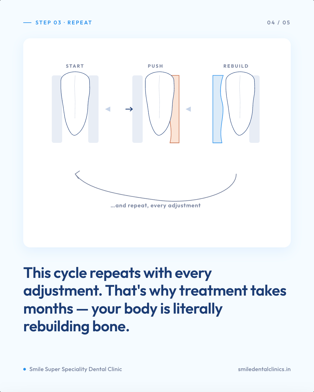 Diagram of the repeating pressure, dissolve, and rebuild cycle in orthodontic tooth movement