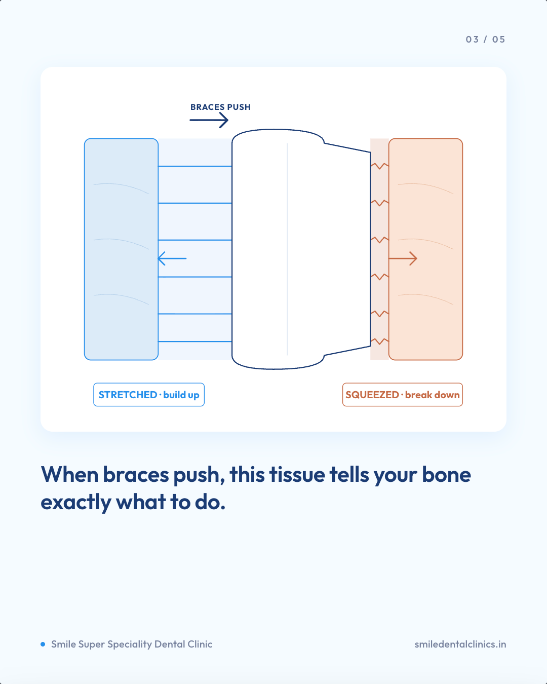 Diagram comparing the squeezed and stretched sides of the periodontal ligament as braces move a tooth