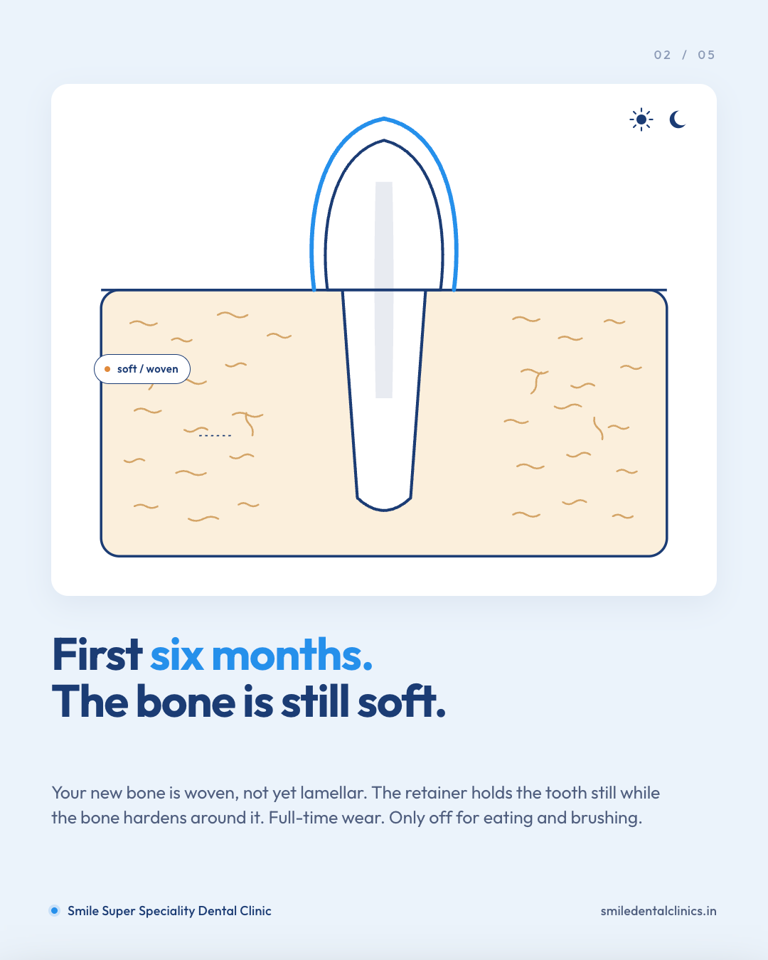 Smile Dental carousel slide on how braces and aligners move teeth and why retention matters