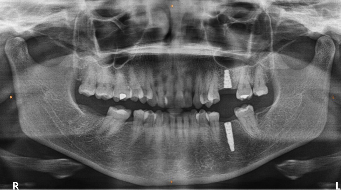 Panoramic X-ray after treatment showing two dental implants on Teja's left side, one in the upper jaw and one in the lower jaw, both in bone
