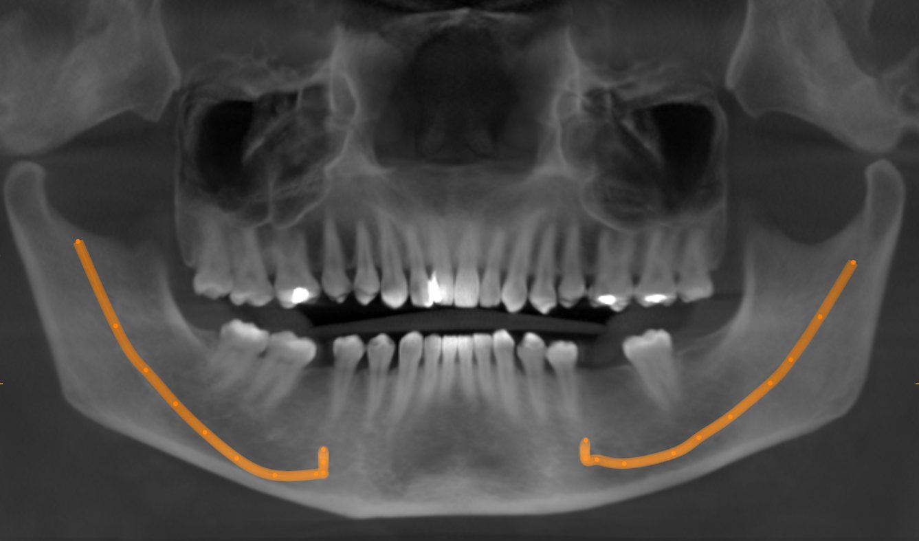 CBCT 3D scan of Teja's upper and lower jaw before dental implants, with the lower jaw nerve canal traced in orange on both sides