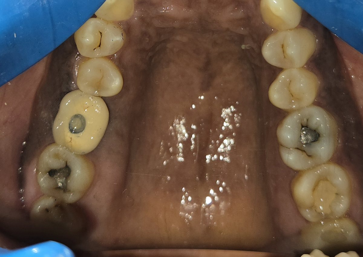 Teja's upper teeth seen from below, with a screw-retained implant crown on a back tooth showing a small sealed screw hole