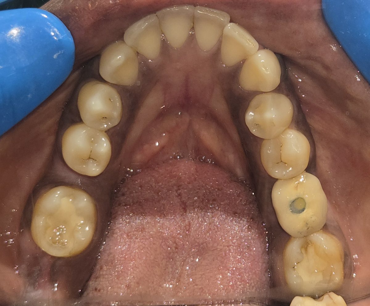 Teja's lower teeth seen from above, with a screw-retained implant crown on the lower left molar and a sealed screw hole in the centre