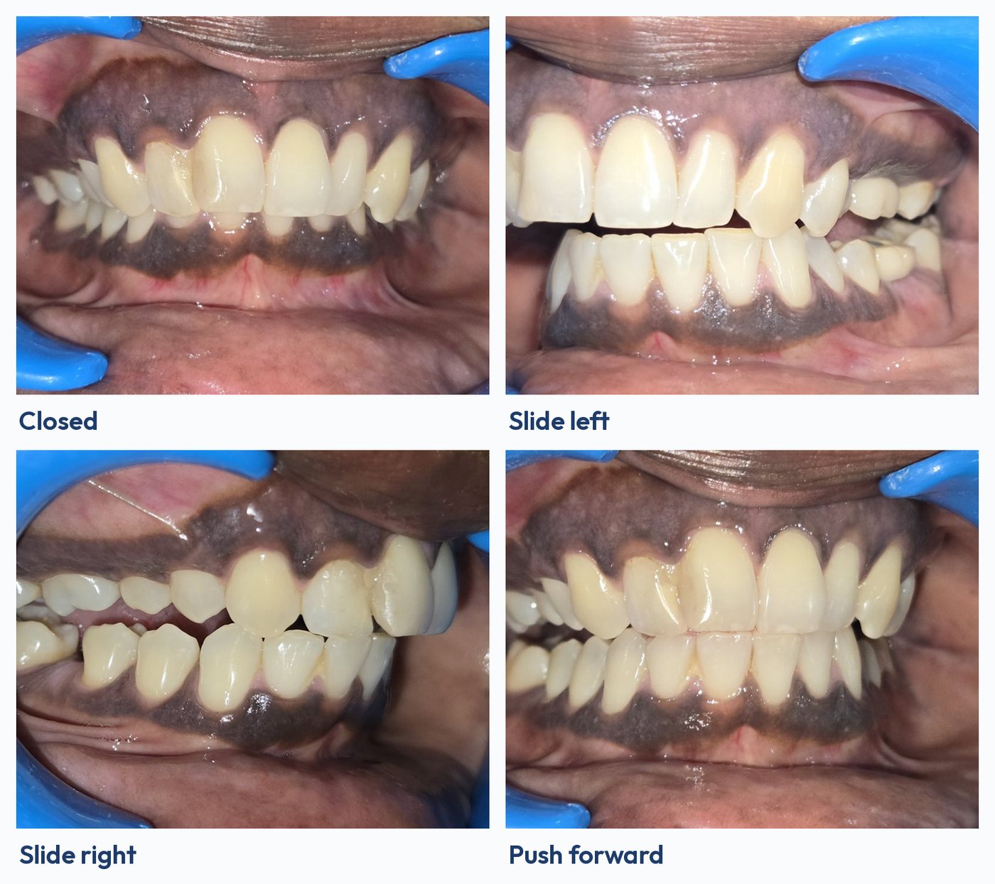 Four photos of Teja's bite checked after dental implants: teeth closed, jaw slid left, jaw slid right and jaw pushed forward
