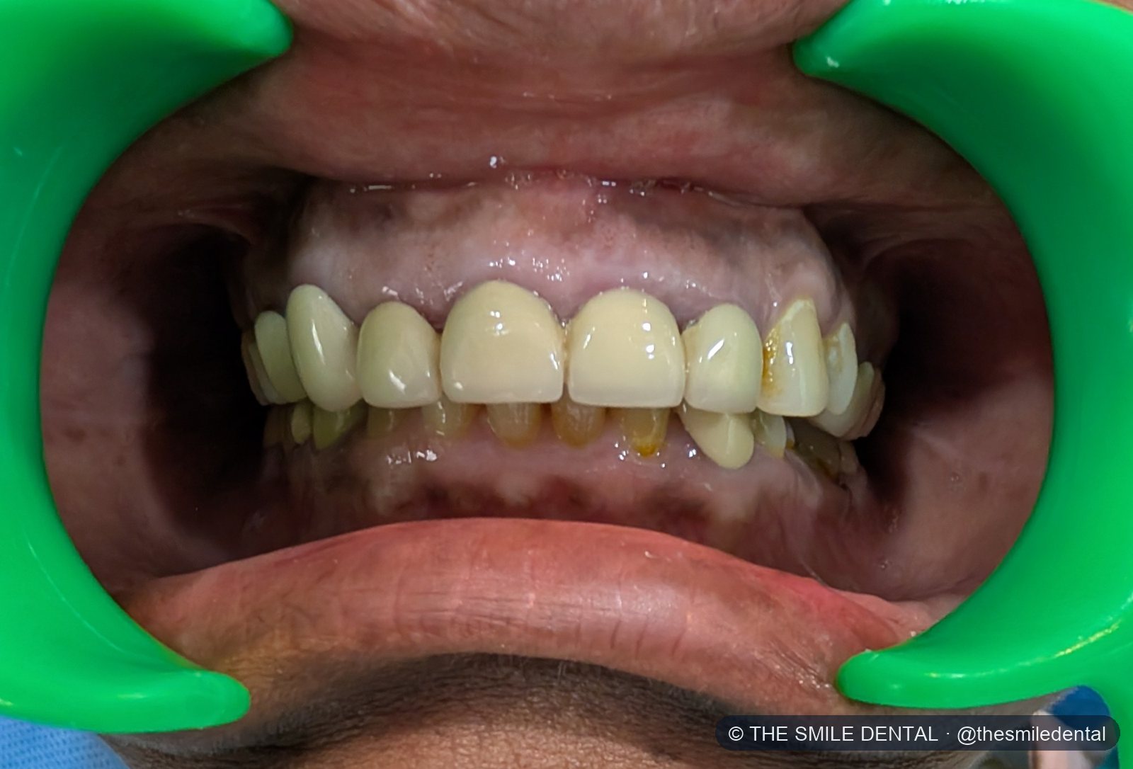 Before treatment