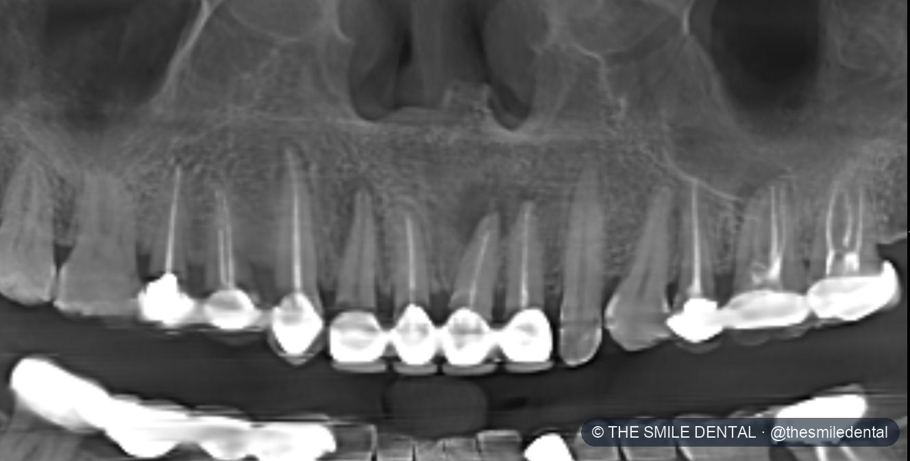 3D scan of the upper jaw before treatment
