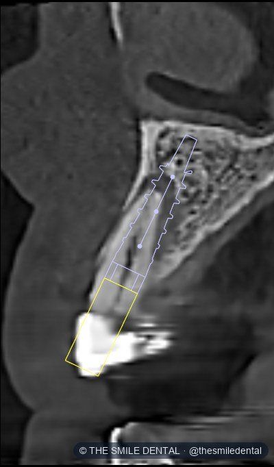 One slice of the scan with a planned implant outlined