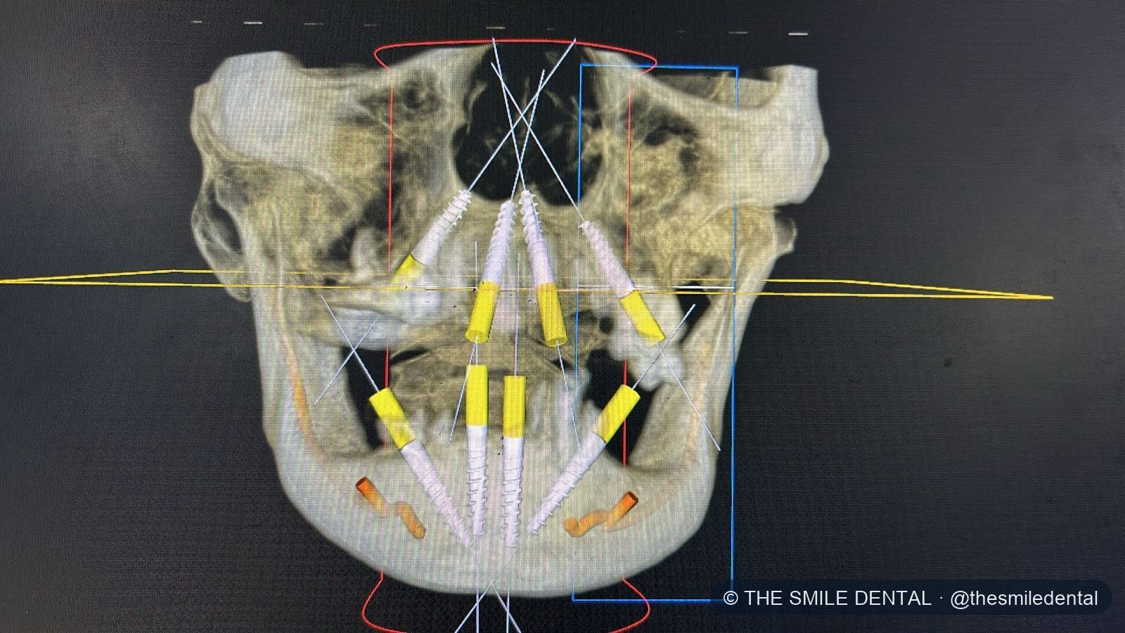3D scan showing the implant plan for both jaws