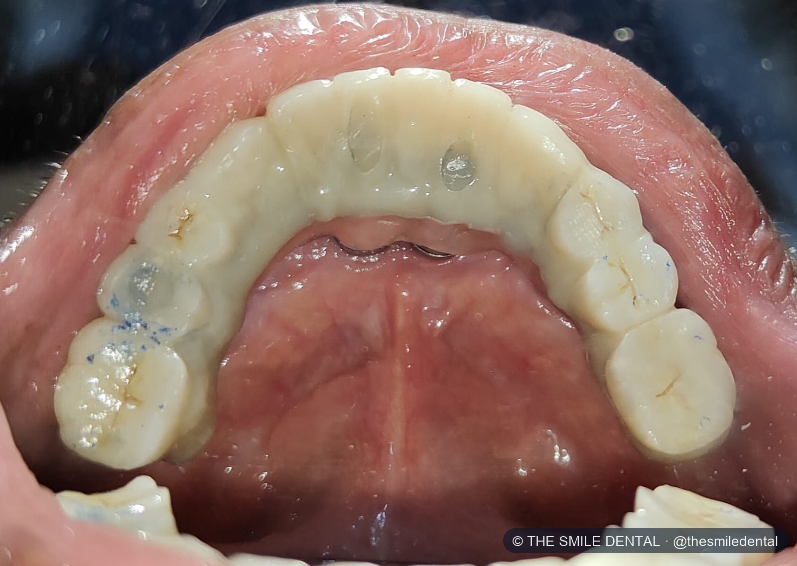 Final upper teeth seen from below