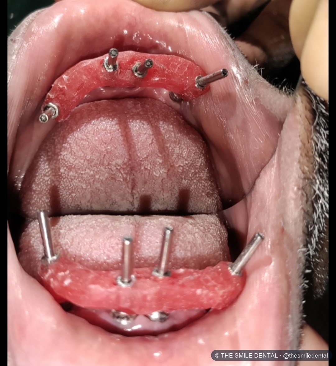 Posts on the implants during the impression stage