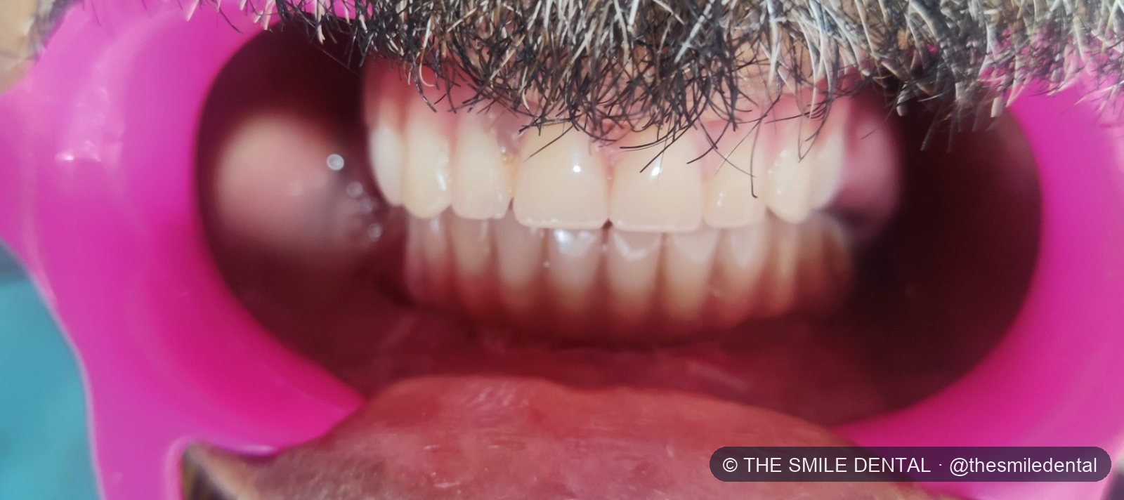 After treatment