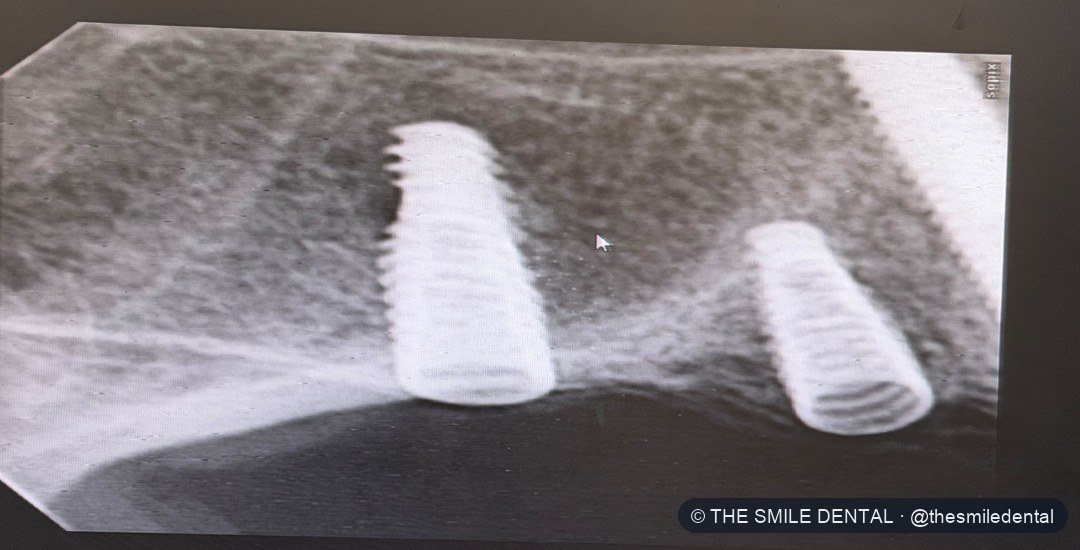 After treatment