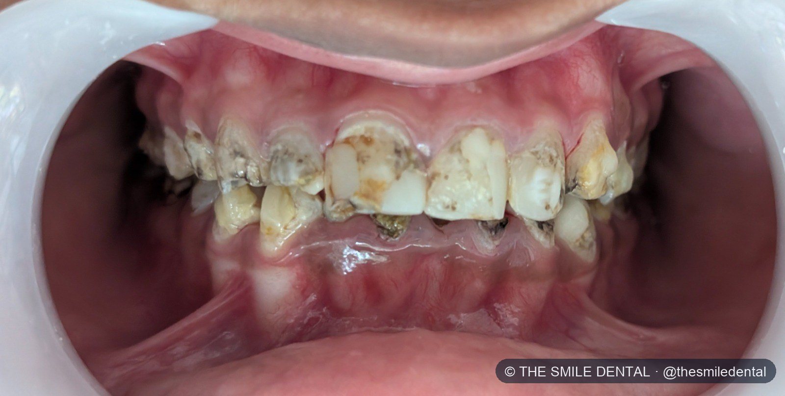 Before treatment